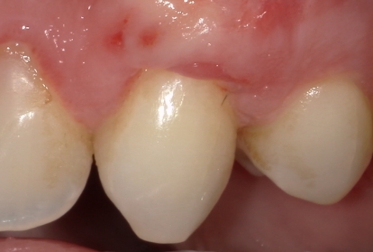 Tooth after gums have been treated