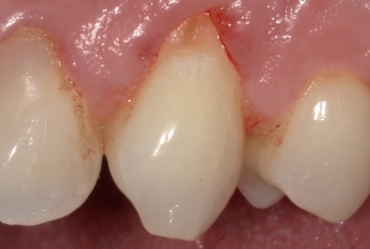 Tooth with roots exposed