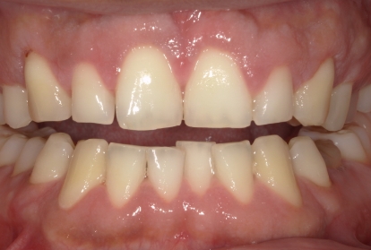 Close up of mouth after Gum reduction treatment