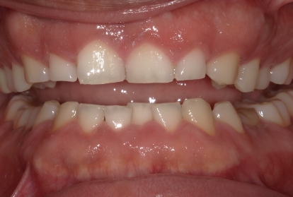 Close up of mouth  before Gum reduction treatment