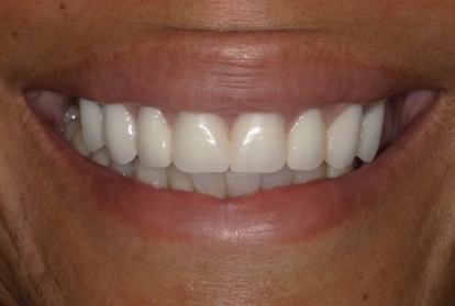 Close up of smile with full set of flawless dental implants