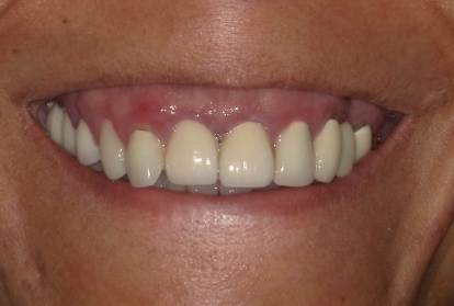 Close up of mouth with several damaged and missing teeth