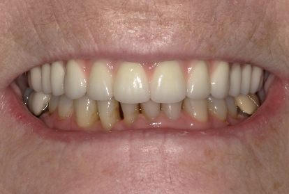 Mouth after treating tooth loss and gum recession
