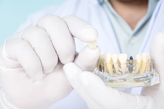 White-gloved hands holding sample dental implant and crown