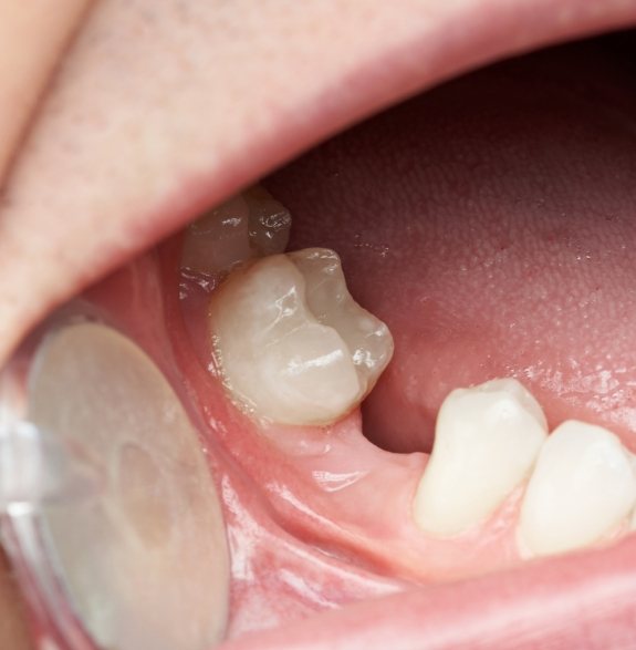 Close up of a mouth with a missing lower tooth