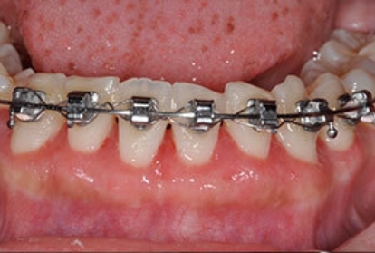 Close up of mouth with braces after pocket reduction treatment