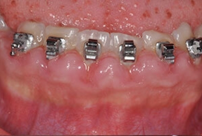 Close up of mouth with braces before pocket reduction treatment