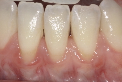 Close up of mouth before gum grafting